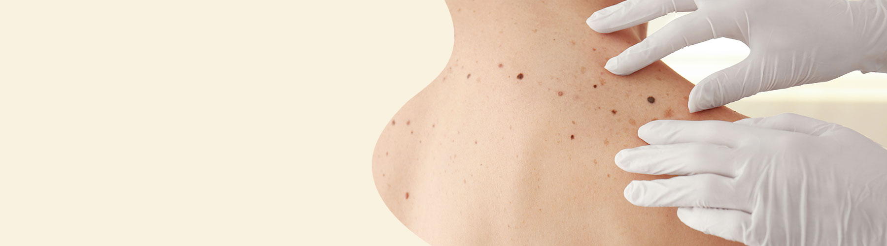 Capital Plastic Surgery, specialist plastic surgeon. General skin cancer surgery. Includes melanoma, basal cell carcinoma, squamous cell carcinoma, cysts, benign lumps. Clinics in Lower Hutt, Porirua and Palmerston North. Wellington region.